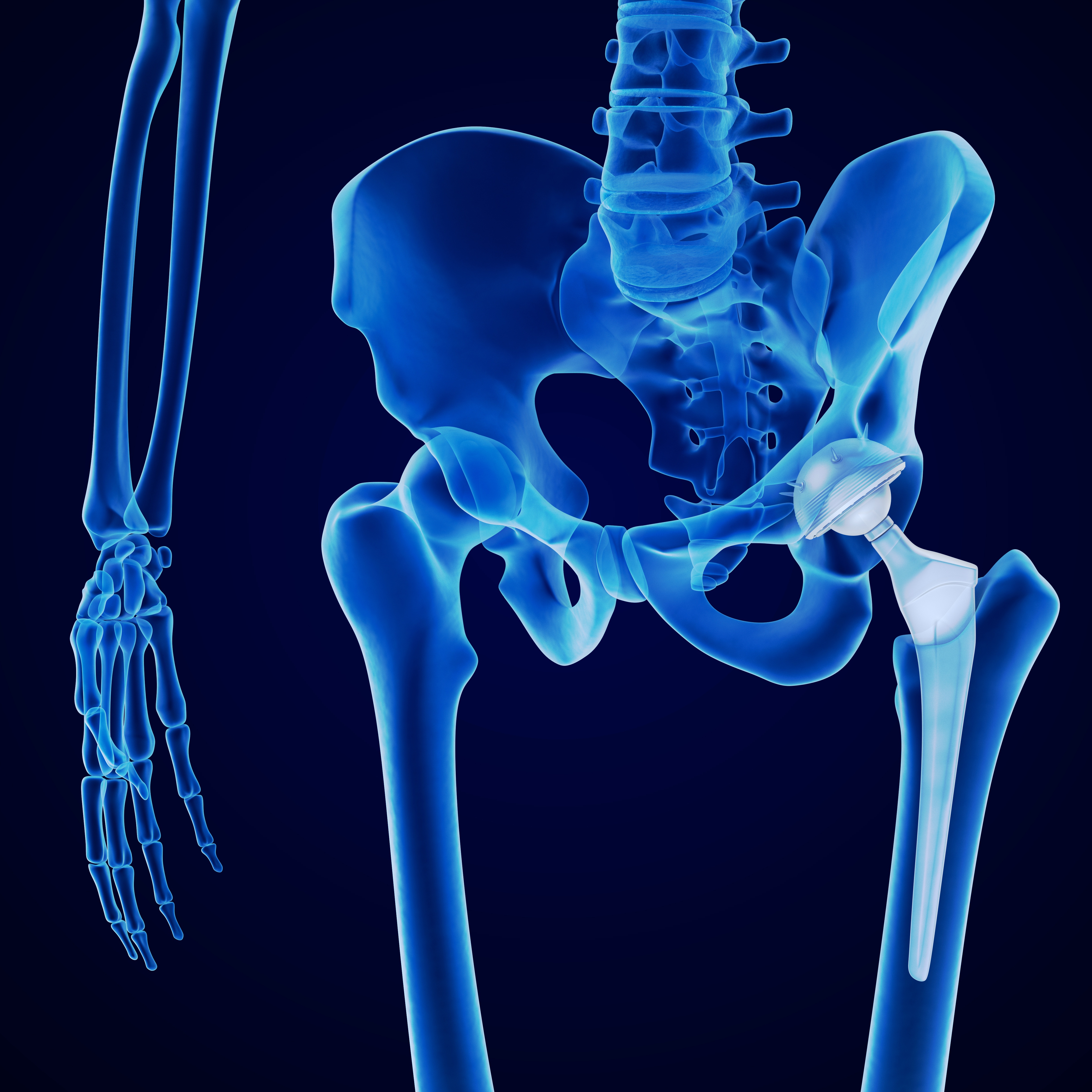 Benefits Of The Anterior Approach To Hip Replacement Surgery